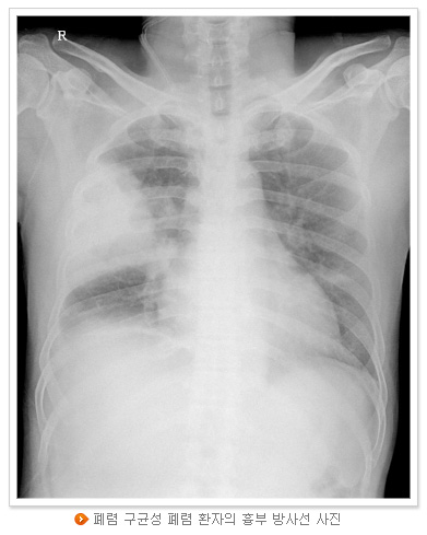폐렴 구균성 폐렴 환자의 흉부 방사선 사진