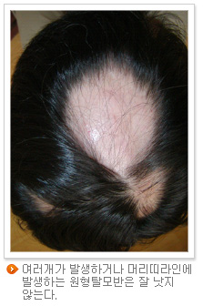 여러개가 발생하거나 머리띠라인에 발생하는 원형탈모반은 잘 낫지 않는다.
