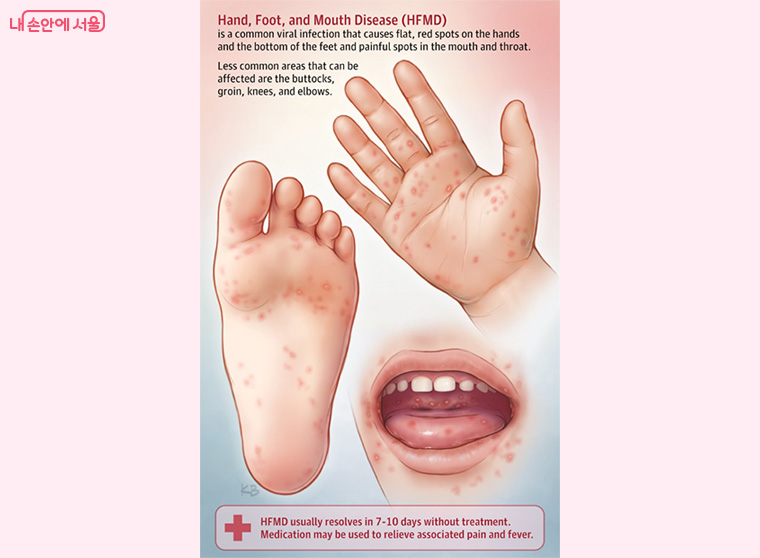 수족구병의 임상적 증상 (출처: JAMA. 2018;320(23):2492. doi:10.1001/jama.2018.17288 )